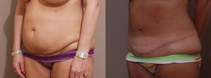 Tummy Tuck Case 82 Before & After View #2 | Webster, TX | Houston Plastic and Reconstructive Surgery
