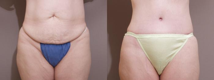 Tummy Tuck Case 96 Before & After View #1 | Webster, TX | Houston Plastic and Reconstructive Surgery
