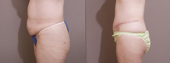 Tummy Tuck Case 96 Before & After View #2 | Webster, TX | Houston Plastic and Reconstructive Surgery